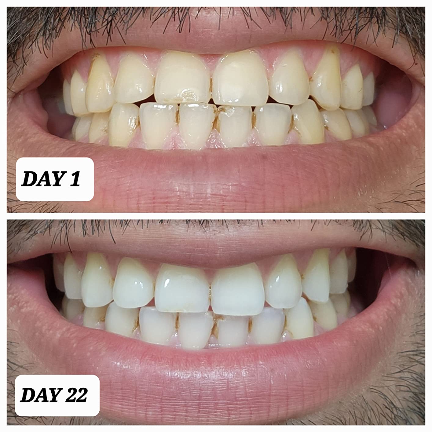 Crest 3D Whitestrips Professional Effects – Teeth Whitening Kit, 22 Treatments (20 + 2 Bonus), Each with 1 Upper/1Lower, 44 Strips – Crest 3DWhite Teeth Whitening Strips Customer Review Crest 3D Whitestrips Professional Effects – Teeth Whitening Kit, 22 Treatments (20 + 2 Bonus), Each with 1 Upper/1Lower, 44 Strips – Crest 3DWhite Teeth Whitening Strips - Customer Photo 1