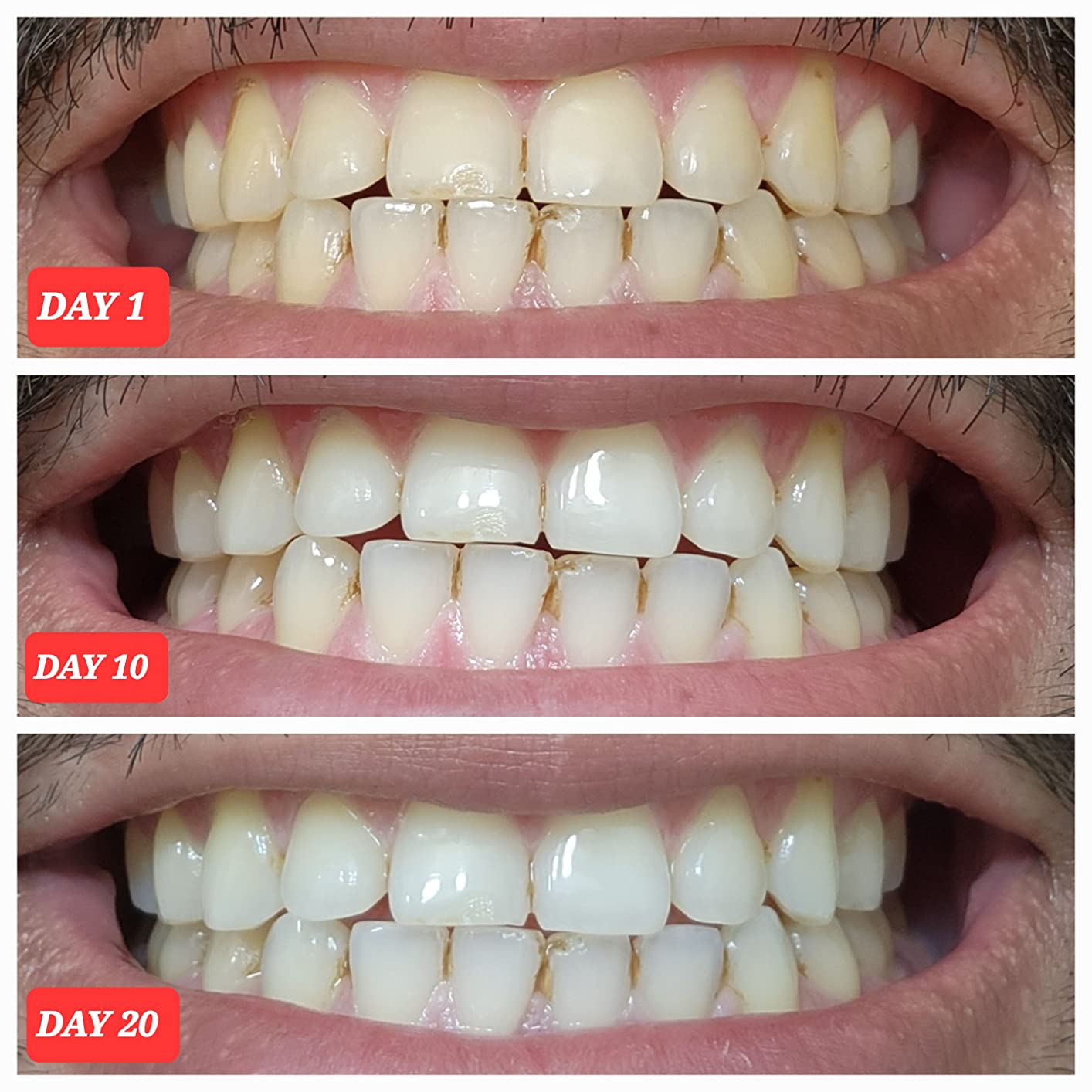 Crest 3D Whitestrips Professional Effects – Teeth Whitening Kit, 22 Treatments (20 + 2 Bonus), Each with 1 Upper/1Lower, 44 Strips – Crest 3DWhite Teeth Whitening Strips Customer Review Crest 3D Whitestrips Professional Effects – Teeth Whitening Kit, 22 Treatments (20 + 2 Bonus), Each with 1 Upper/1Lower, 44 Strips – Crest 3DWhite Teeth Whitening Strips - Customer Photo 2