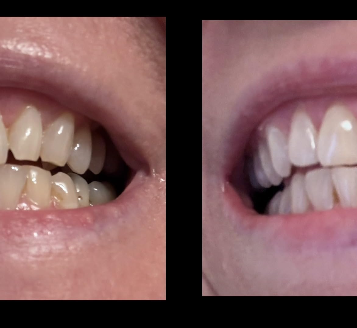 Lumineux Teeth Whitening Strips Kit - 9 Treatments - Peroxide Free - Enamel Safe for Whiter Teeth - Whitening Without The Sensitivity - Dentist Formulated - Sensitivity Free Customer Review Lumineux Teeth Whitening Strips Kit - 9 Treatments - Peroxide Free - Enamel Safe for Whiter Teeth - Whitening Without The Sensitivity - Dentist Formulated - Sensitivity Free - Customer Photo 1