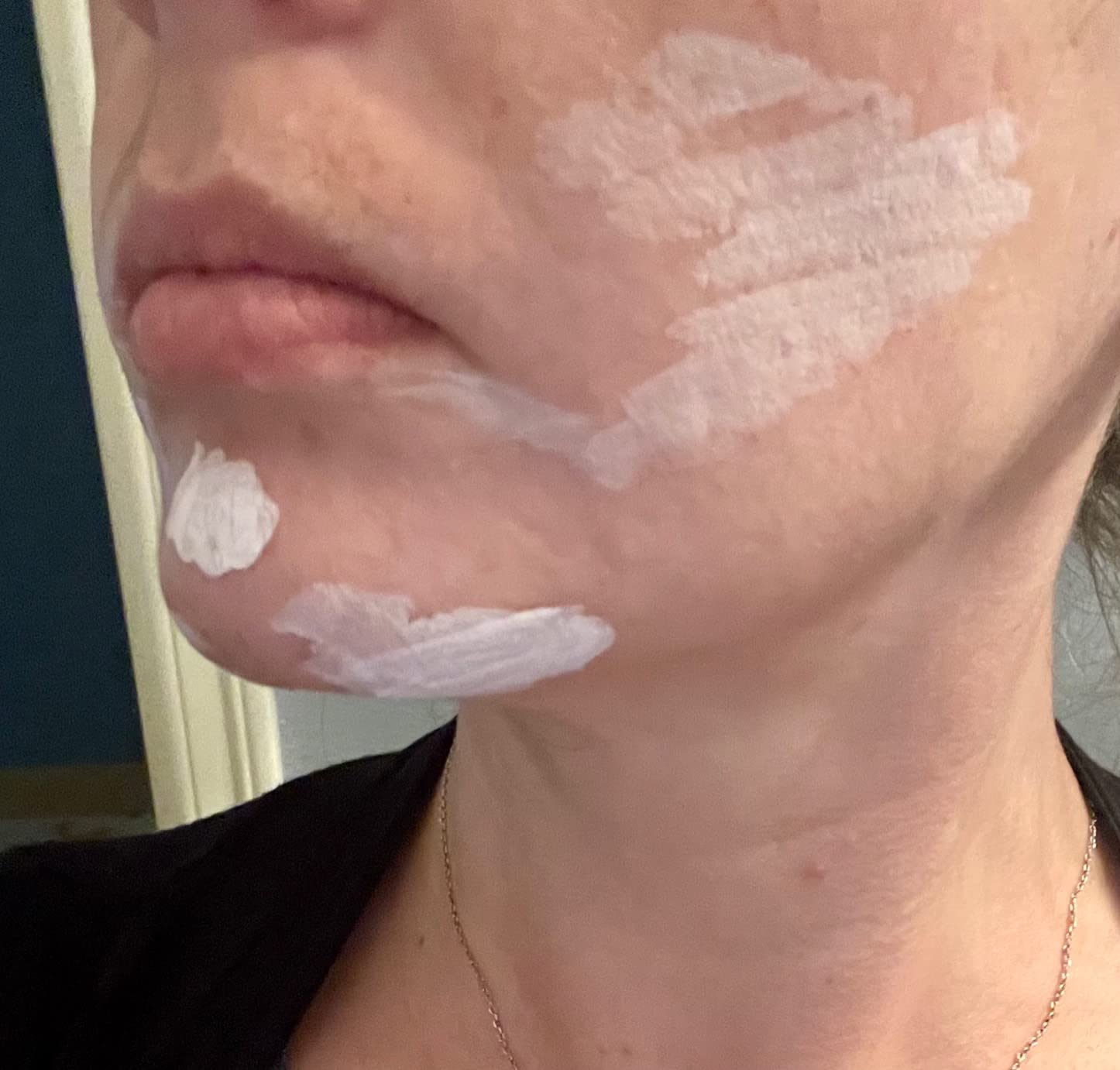 COSRX Acne Blemish Spot Drying Lotion 1.01 fl. oz / 30ml Dry and Reduce Blemish Spot, Pimple, Whitehead, Spot Treatment, Korean Skin Care Customer Review COSRX Acne Blemish Spot Drying Lotion 1.01 fl. oz / 30ml Dry and Reduce Blemish Spot, Pimple, Whitehead, Spot Treatment, Korean Skin Care - Customer Photo 2