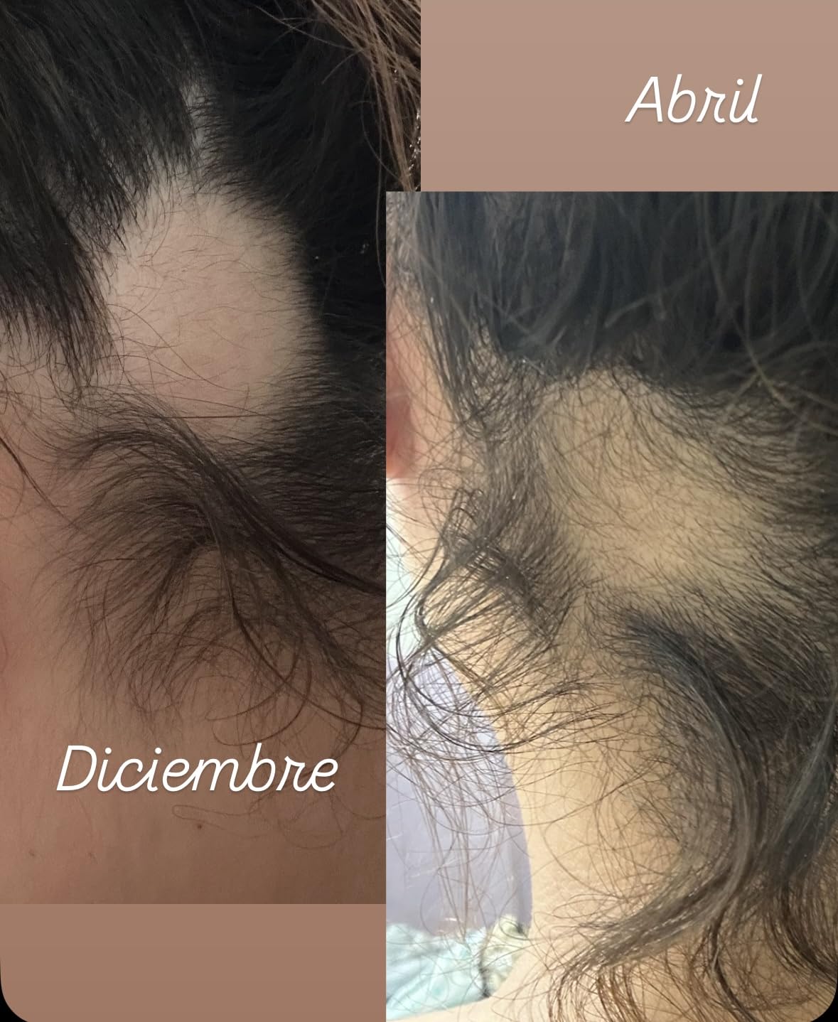 MONAT IR Clinical System – Complete Hair Care Restoration Kit with Thickening Shampoo, Conditioner & Thinning Defense Serum – Strengthens, Protects, & Revives Hair for Thicker, Fuller-Looking Results Customer Review MONAT IR Clinical System – Complete Hair Care Restoration Kit with Thickening Shampoo, Conditioner & Thinning Defense Serum – Strengthens, Protects, & Revives Hair for Thicker, Fuller-Looking Results - Customer Photo 2